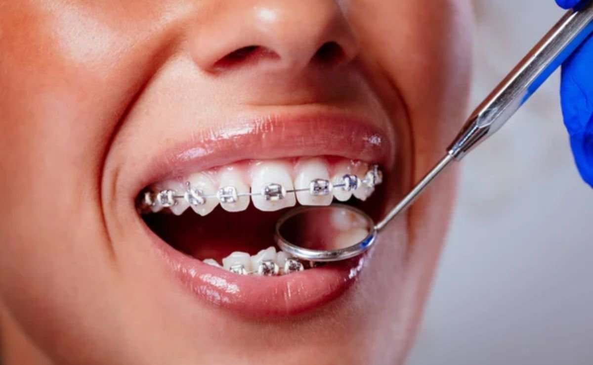 Apa Itu Braces Gigi?