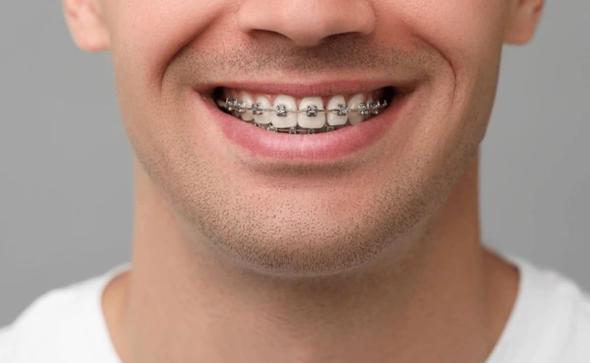 Traditional Braces