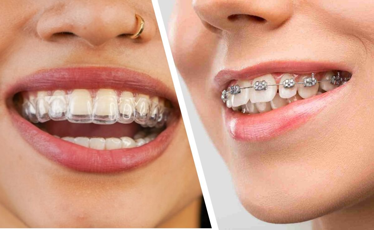 Invisible Braces vs Traditional Braces: Key Differences