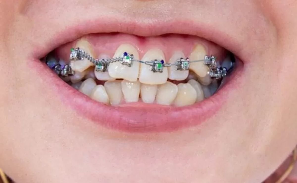 Who Should Choose Traditional Braces?