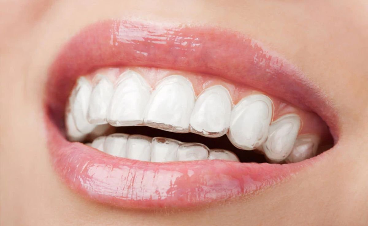 Who Should Choose Invisible Braces?