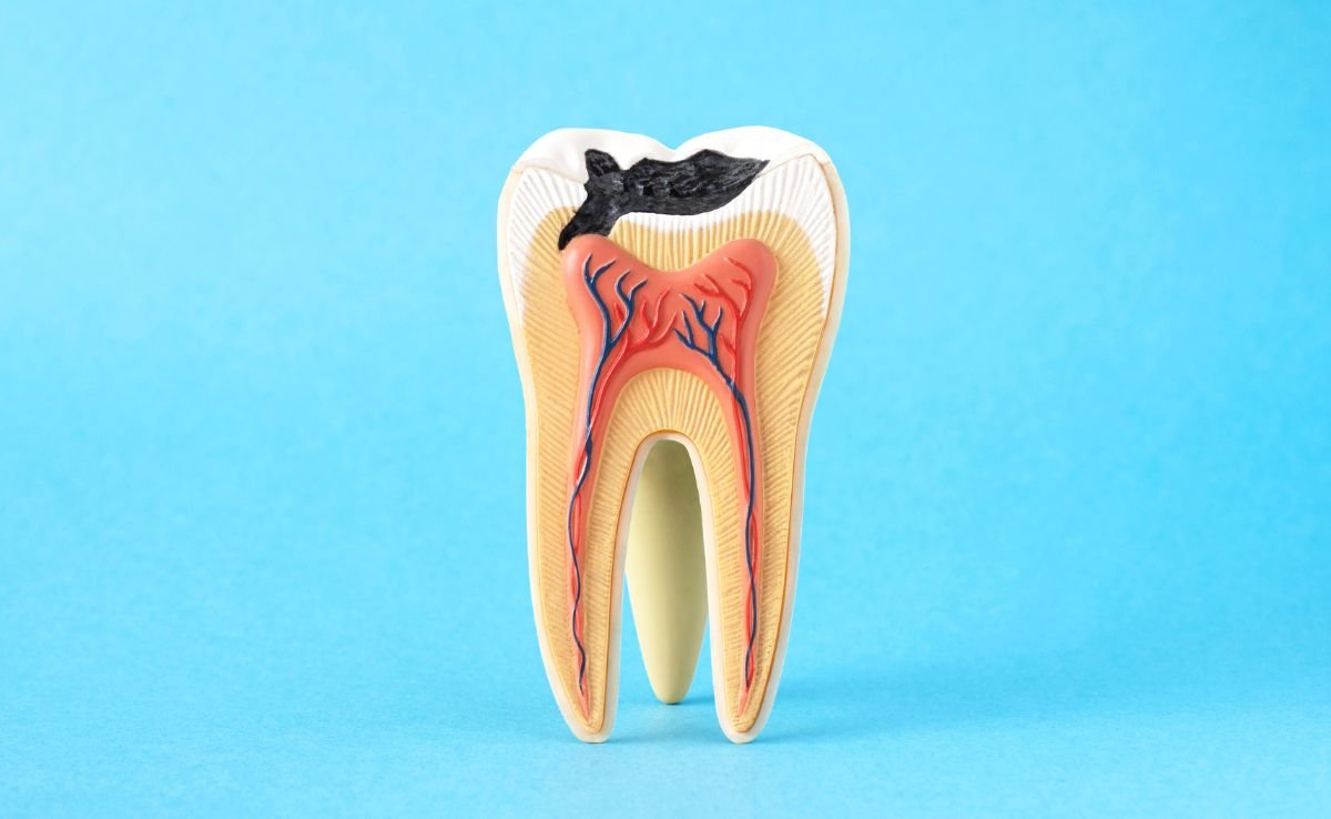 What Causes a Tooth Cavity?