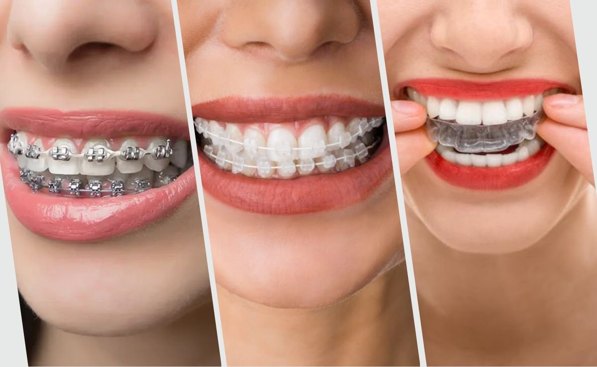 Jenis Braces yang Terdapat di Malaysia : Braces Metal, Braces Ceramic & Clear Aligners