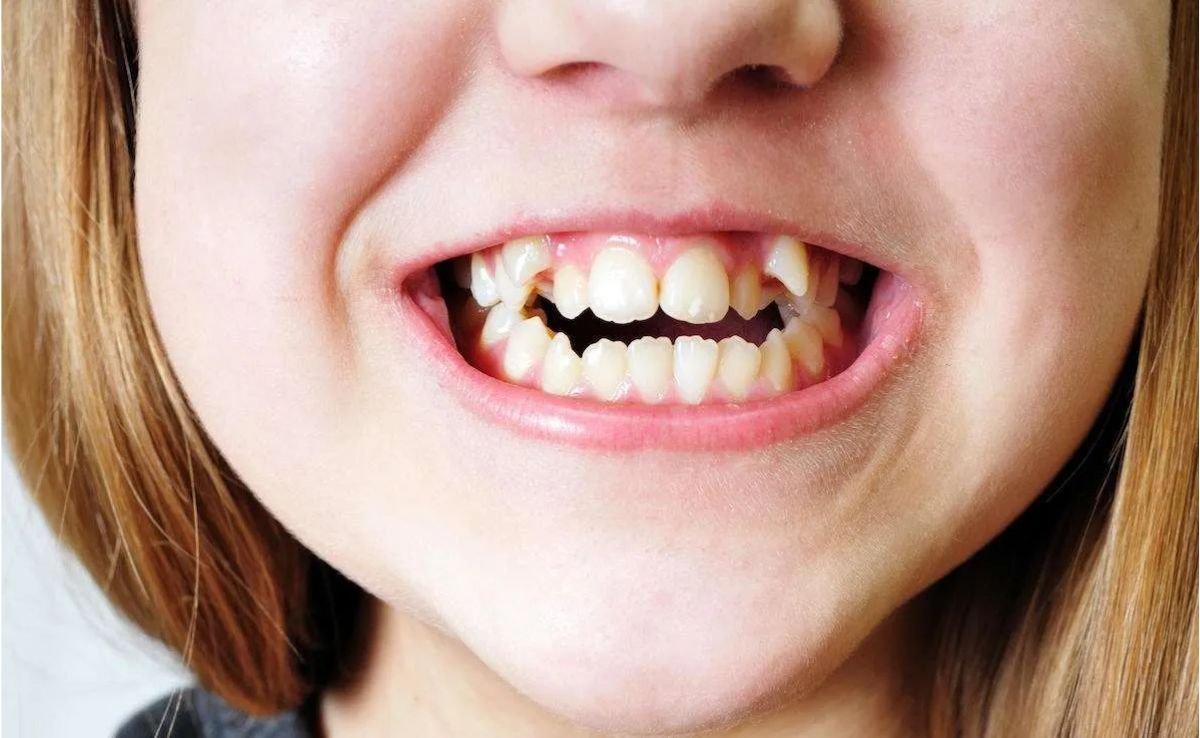 Jenis Gigi yang Boleh Pakai Braces: Gigi berlapis atau tidak tersusun 