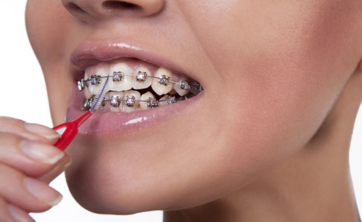 Penjagaan Semasa Memakai Braces