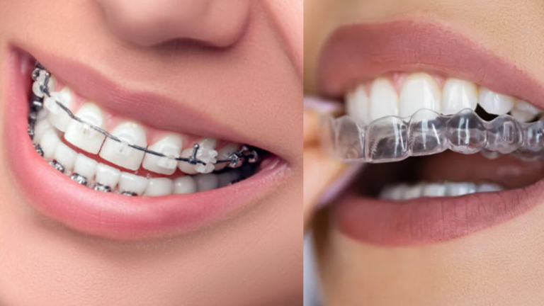 Damon braces and invisalign side by side