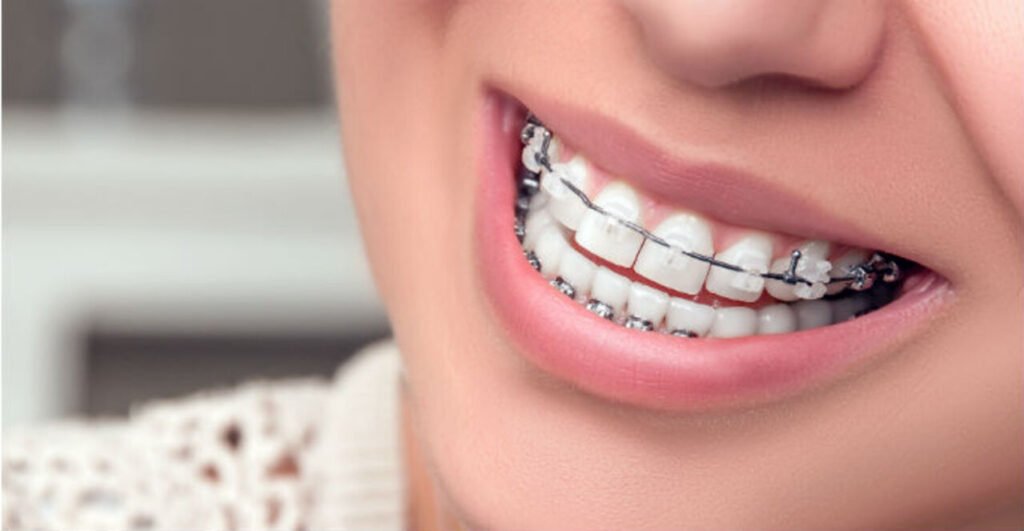 damon braces on teeth