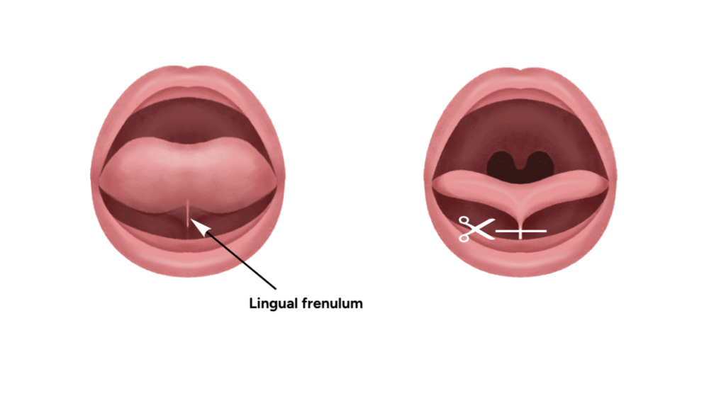 frenotomy