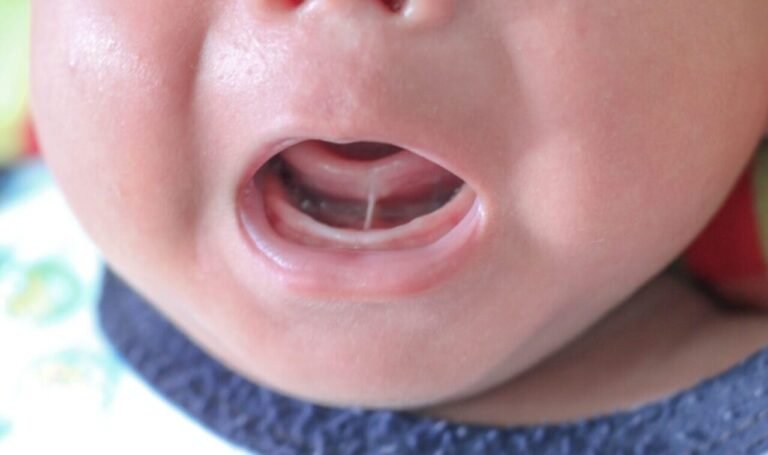 baby with tongue tie