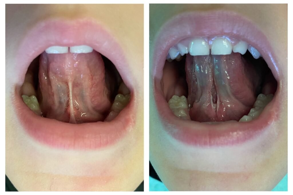 frenulectomy