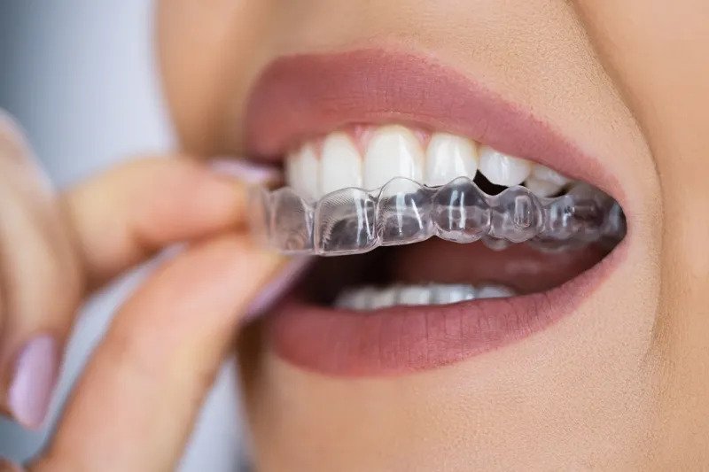 invisalign clear aligners on teeth