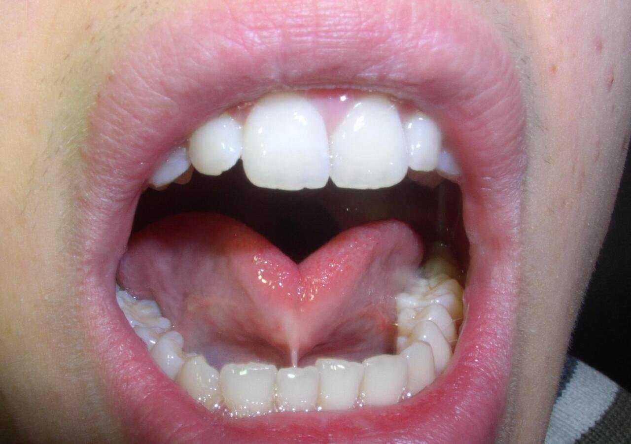 tongue tie