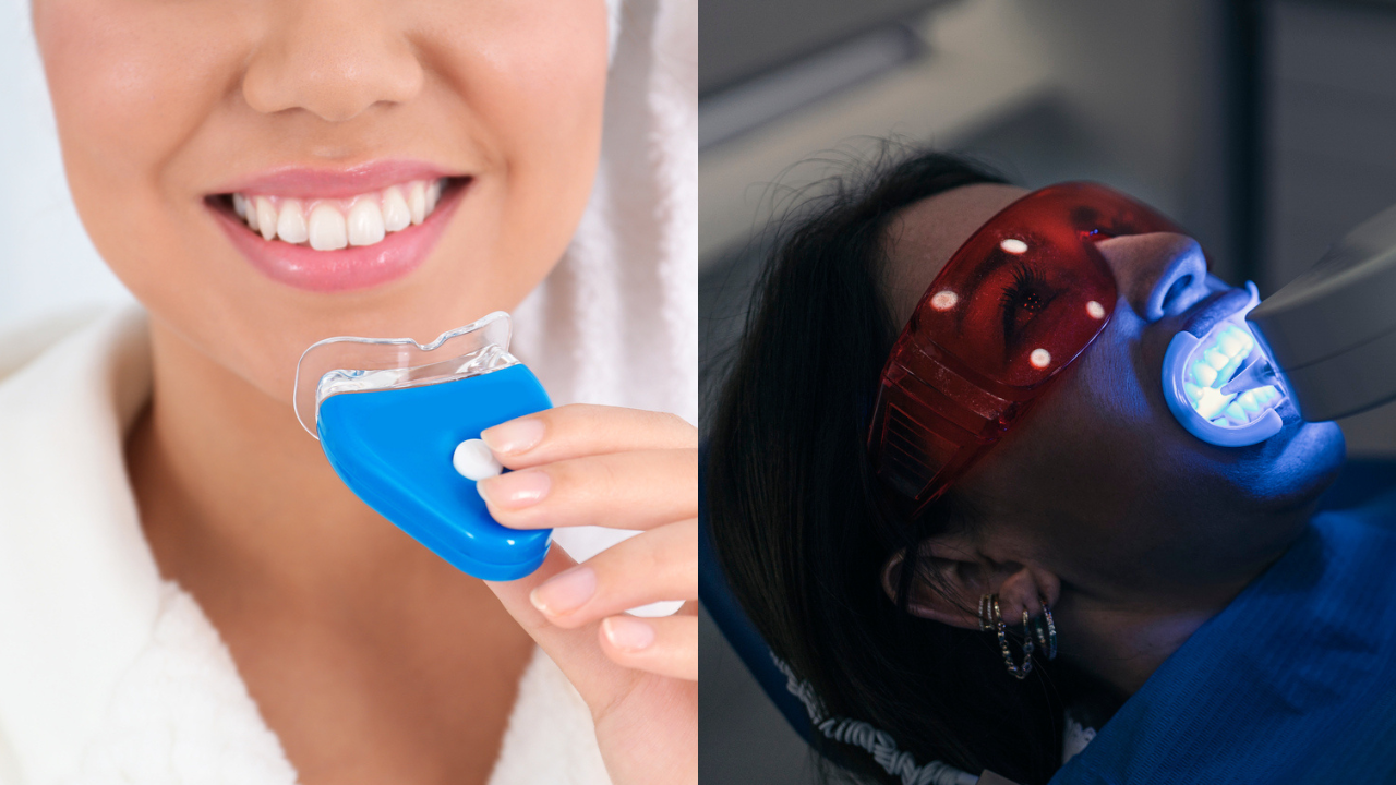 at home vs clinical whitening
