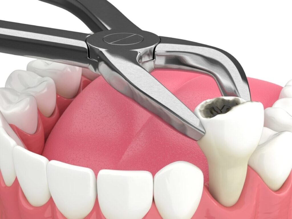diagram of a damaged tooth getting extracted