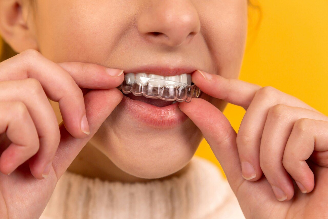 woman fitting her clear aligners into her mouth