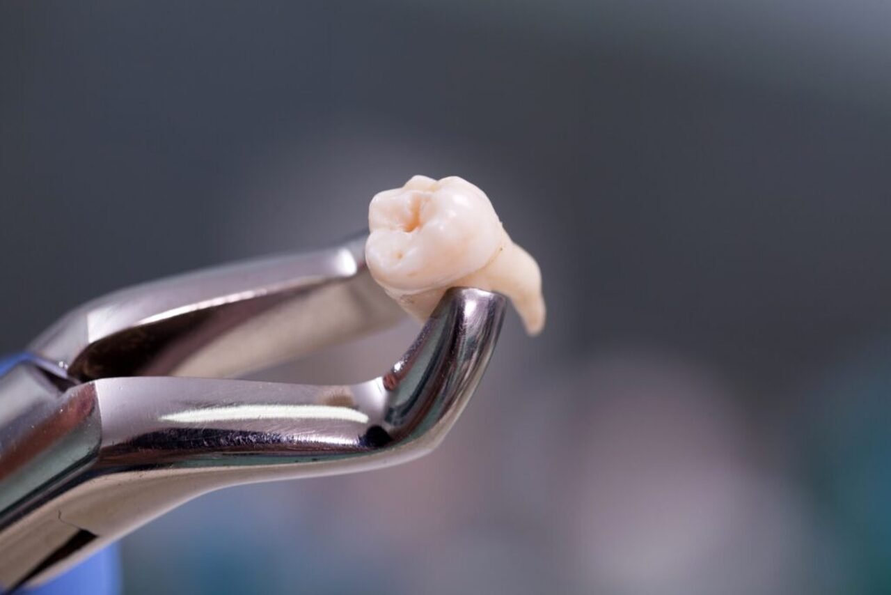 dental plier holding a tooth