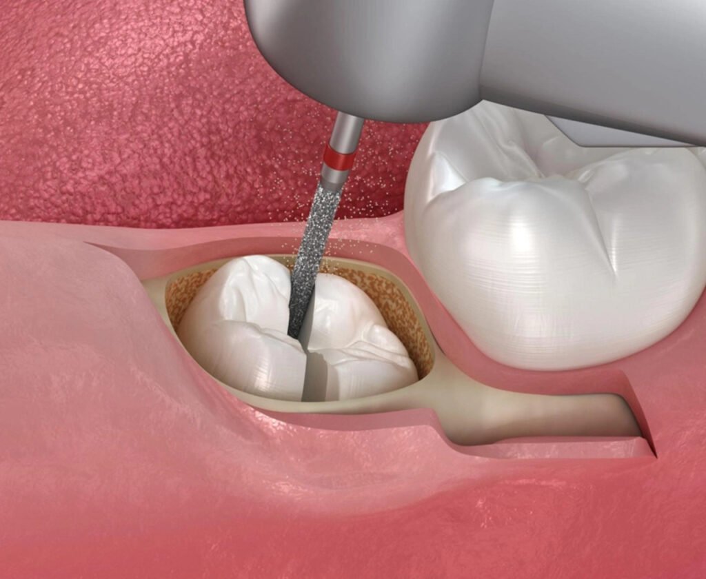 drill being used by dentist to section the tooth to be extracted