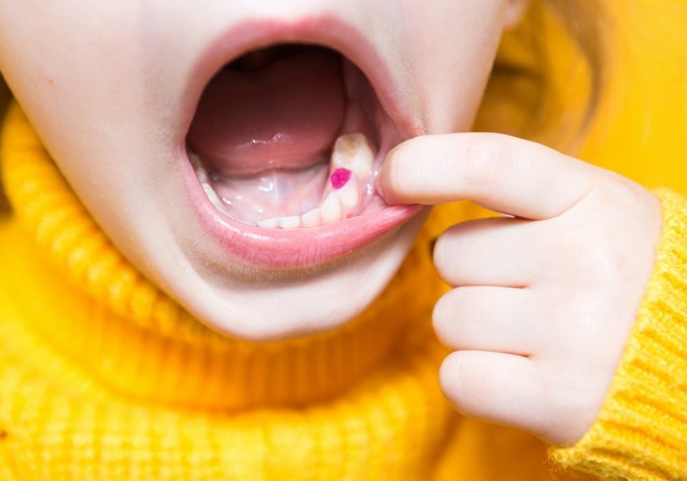 Colored purple filling on the girl's milk chewing tooth. Pediatric dentistry,