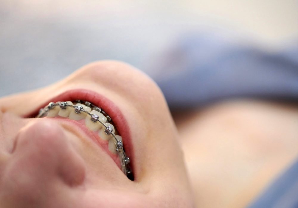 Smiling young woman with brackets on teeth close up. Metal self-ligating dental braces.