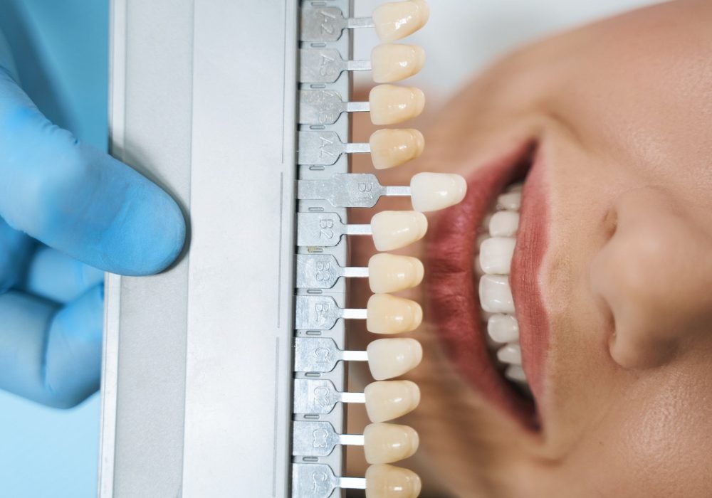 Top view of dentist with veneers palette stock photo